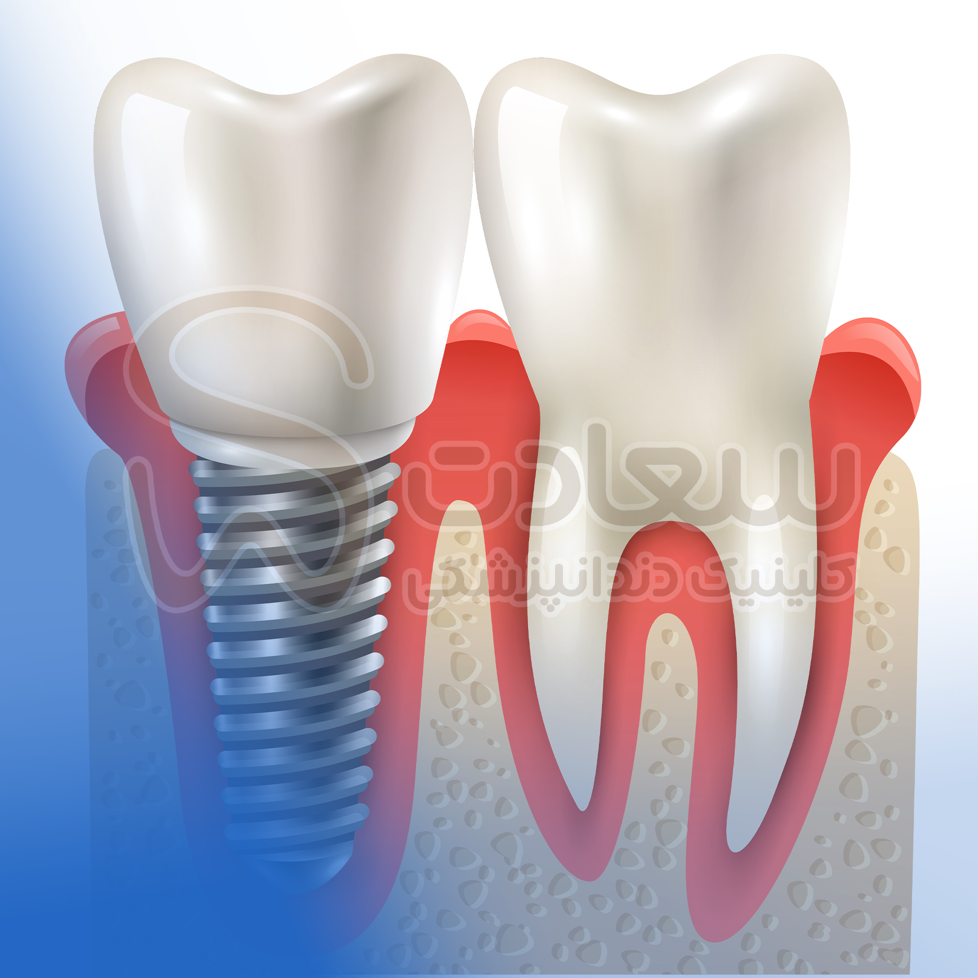 implant بهترین کلنیک دندانپزشکی مشهد ارائه کلیه خدمات دندانپزشکی با بهترین تجهیزات و اتاق عمل بیهوشی