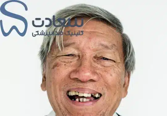 افراد کاندید کامپوزیت دندان در مشهد