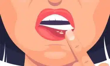 آفت دهان
