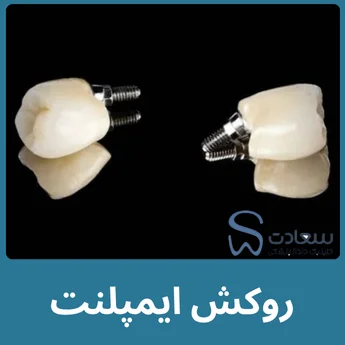 روکش ایمپلنت دندان مشهد