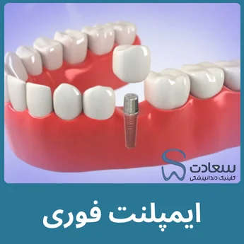 ایمپلنت در مشهد چگونه انجام میشود