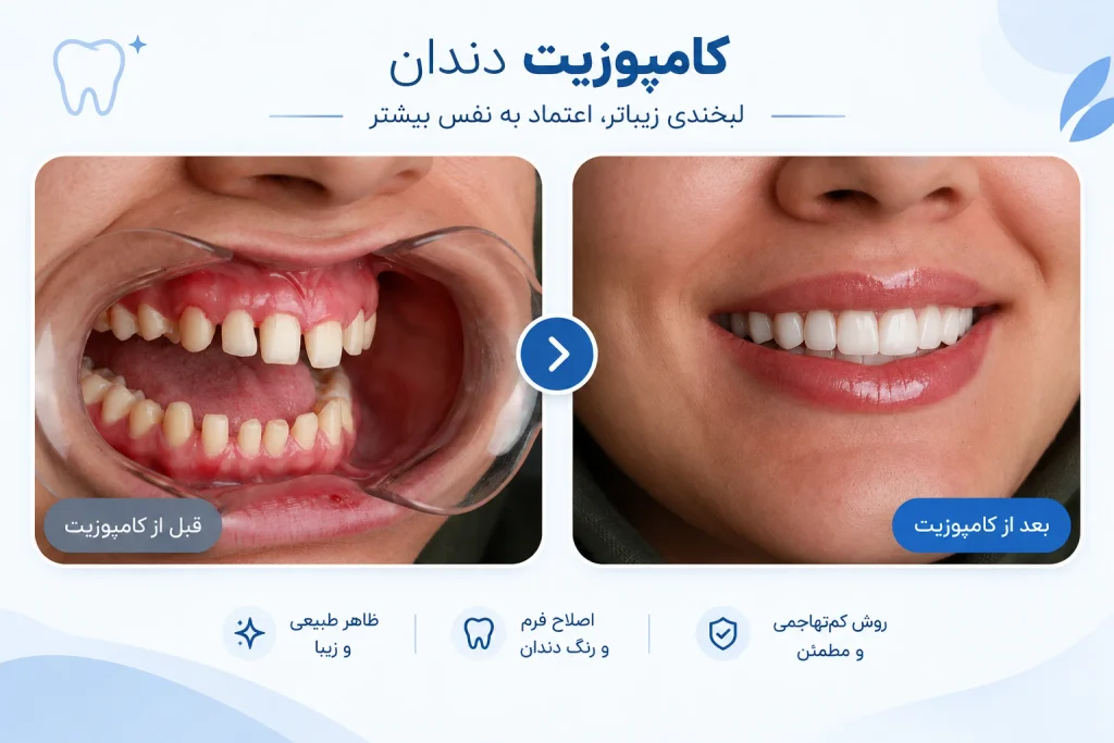 قبل و بعد کامپوزیت دندان