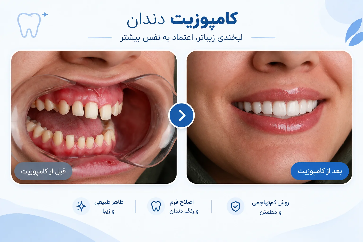 composite dental