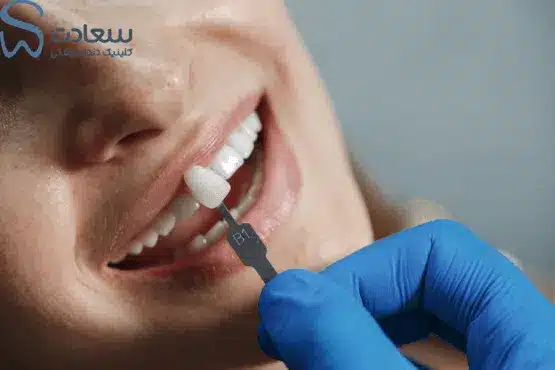 مزایای ونیر کامپوزیت در مشهد