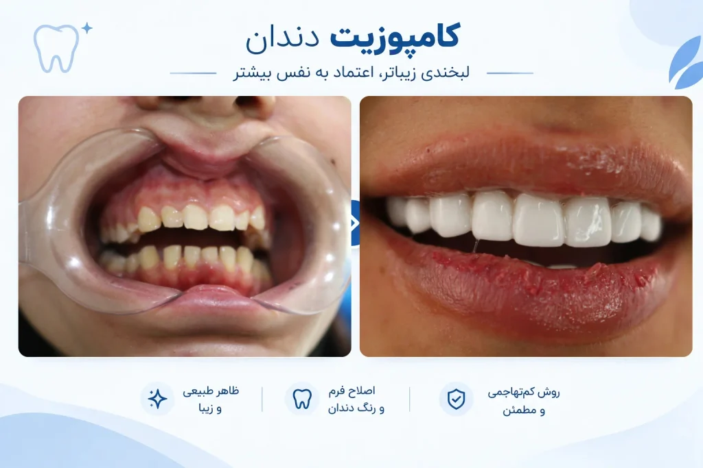 قبل و بعد کامپوزیت دندان در مشهد