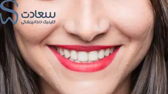 معایب ونیر کامپوزیت دندان در مشهد