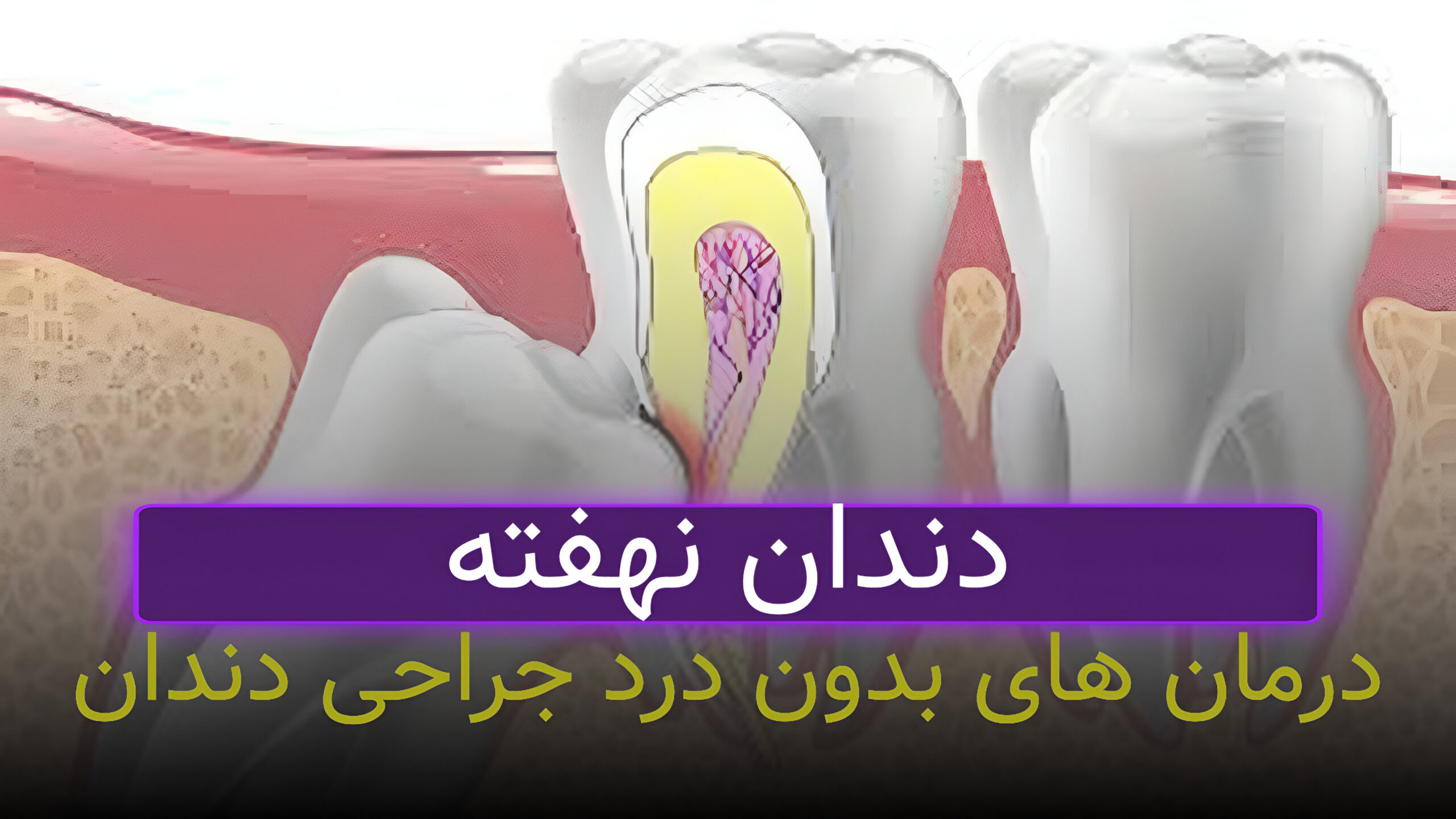 دندان نهفته و جراحی آن