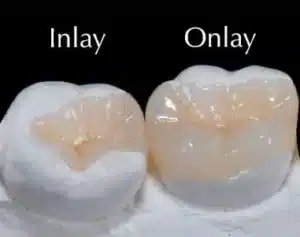 اینله دندان