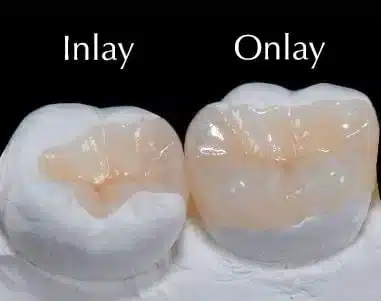 اینله دندان