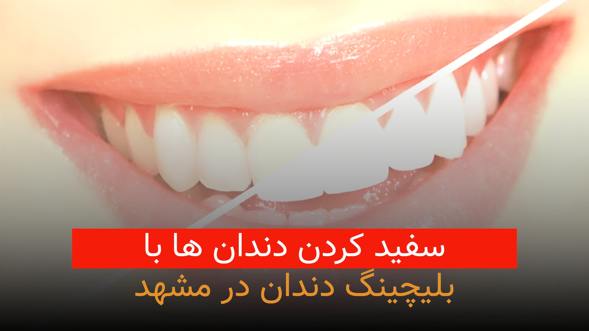 بلیچینگ دندان در مشهد