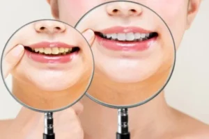 قیمت بلیچیننگ دندان