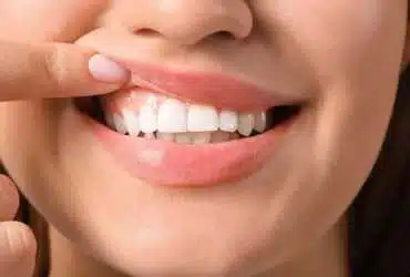 جراحی لثه در مشهد