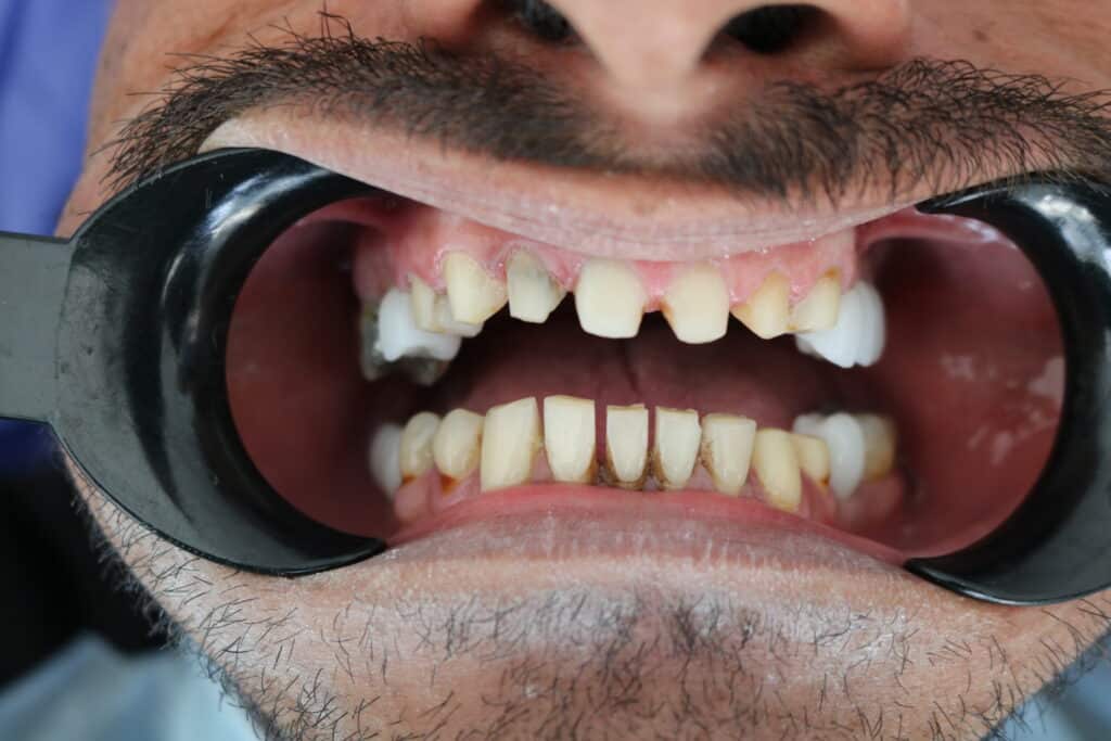 قبل از لیمنت مشهد