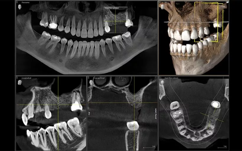 تشخیص زودهنگام بیماری‌های لثه با تصویربرداری دیجیتال پیشرفته