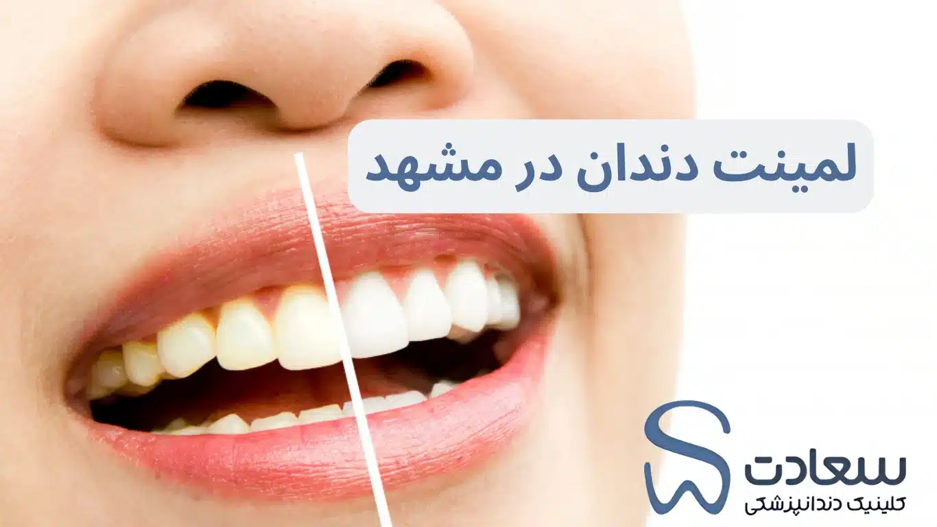 چرا لمینت دندان محبوب‌ترین درمان زیبایی در مشهد است؟
