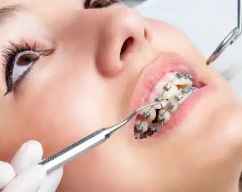 بریس ثابت چیست؟