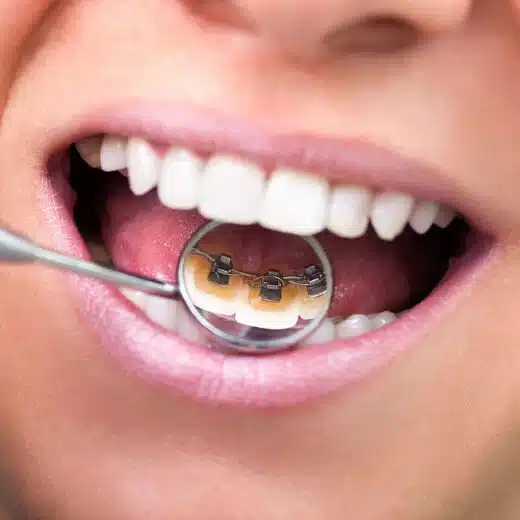 “بریس های نامرئی” چیست؟
