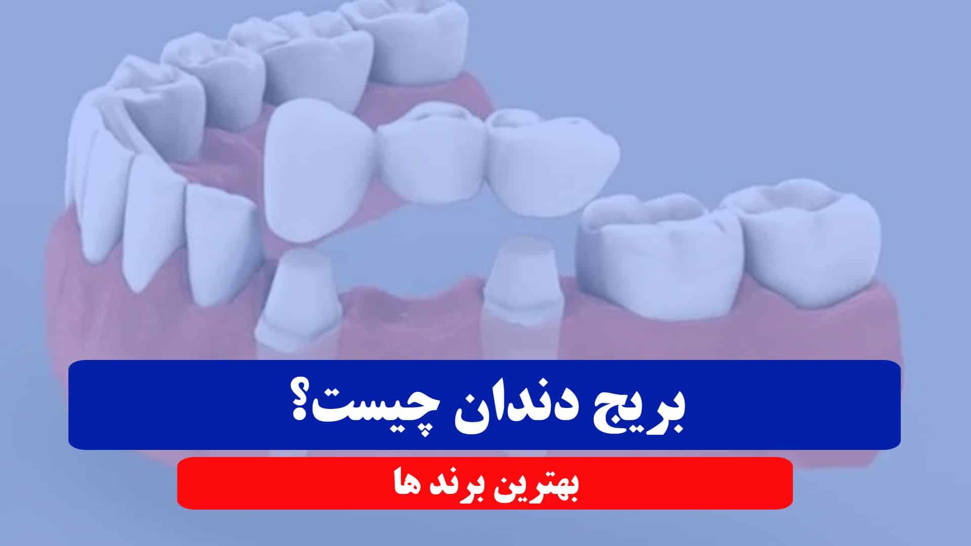 بریج دندان - بهترین کلینیک دندانپزشکی مشهد 1404