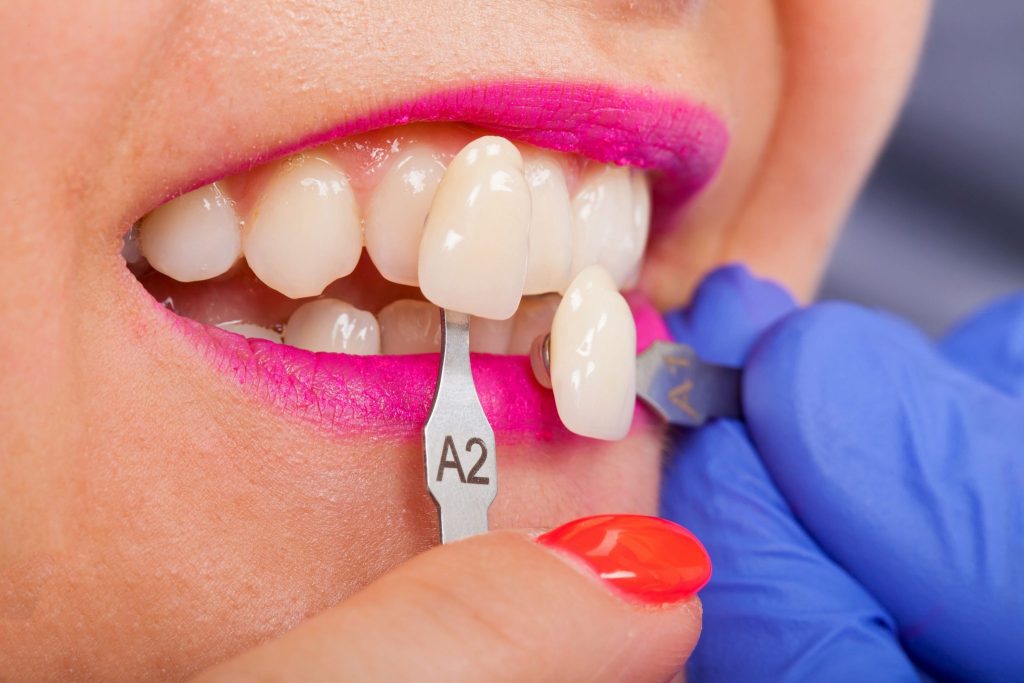 چگونه از عوارض روکش دندان پیشگیری کنیم؟
