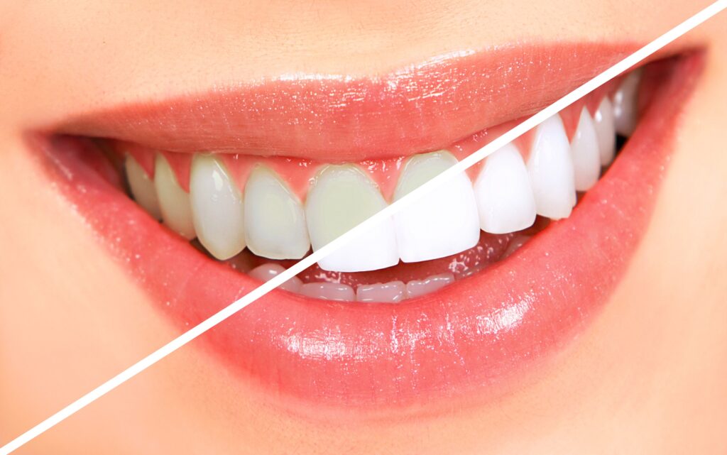 ?What Is a Dental Crown and How Does It Work