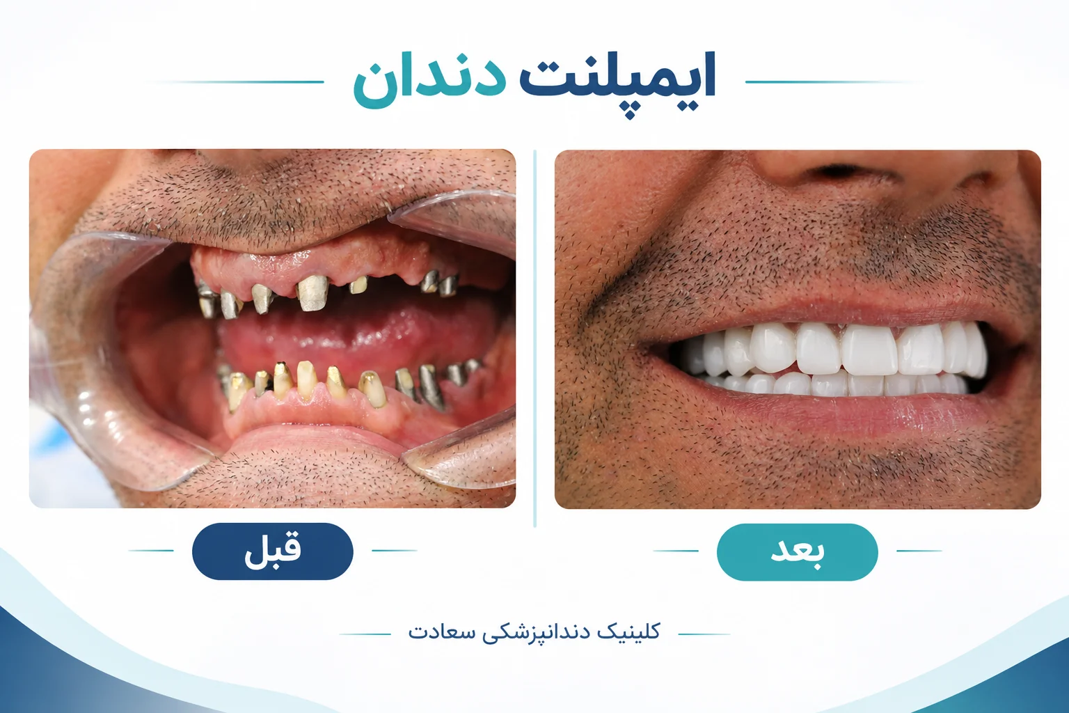 Dental Implant Before and After