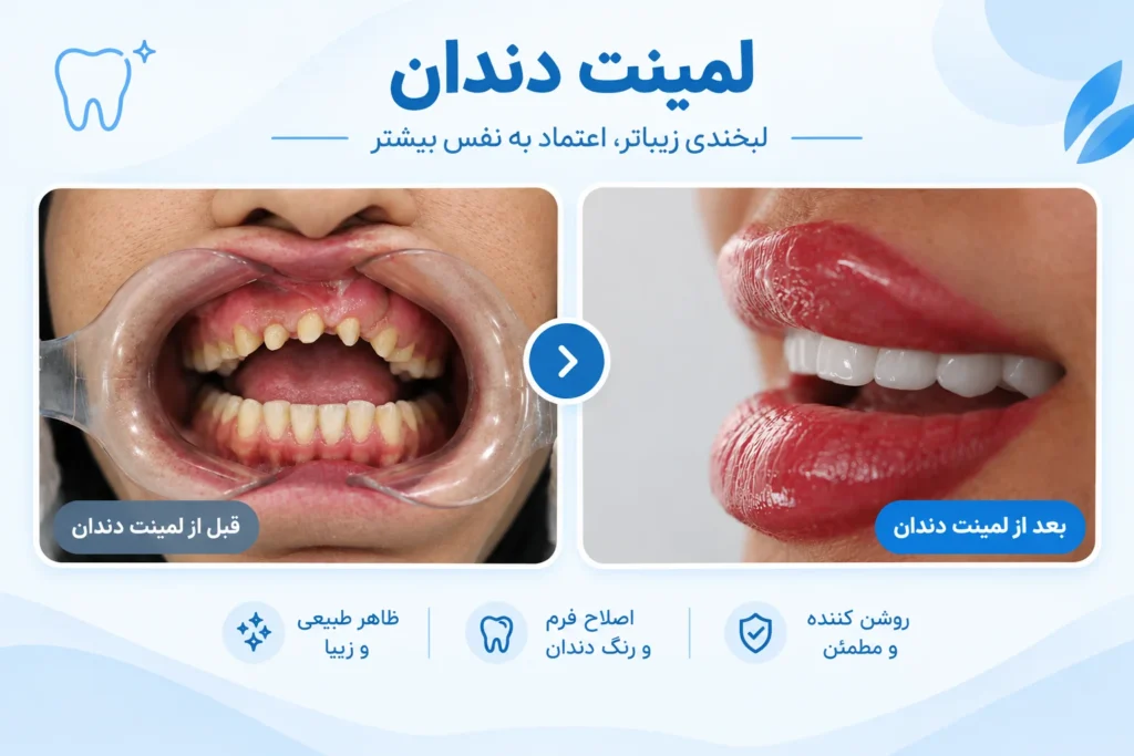 لمینت دندان در مشهد