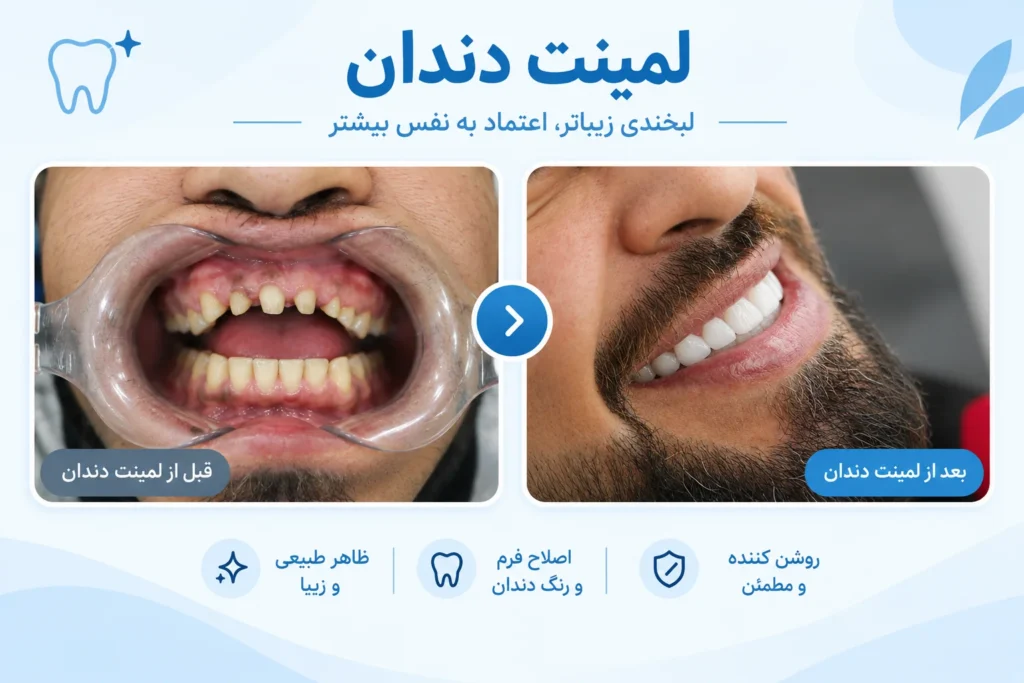 قیمت لمینت دندان در مشهد