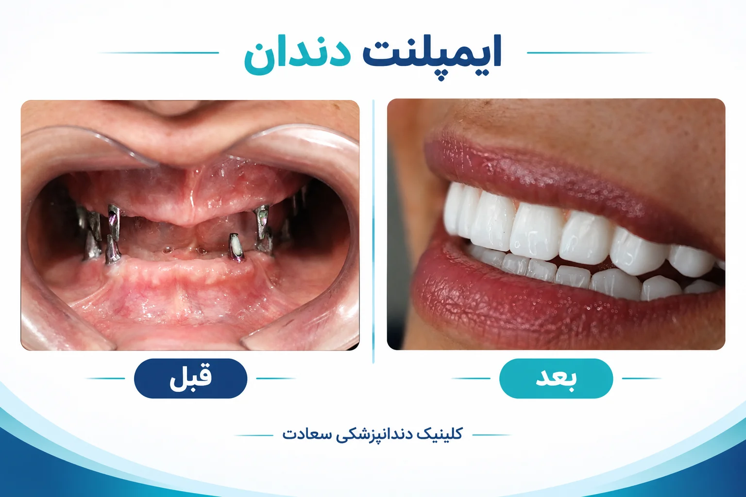 بهترین نمونه کار ایملپنت دندان کلینیک سعادت مشهد